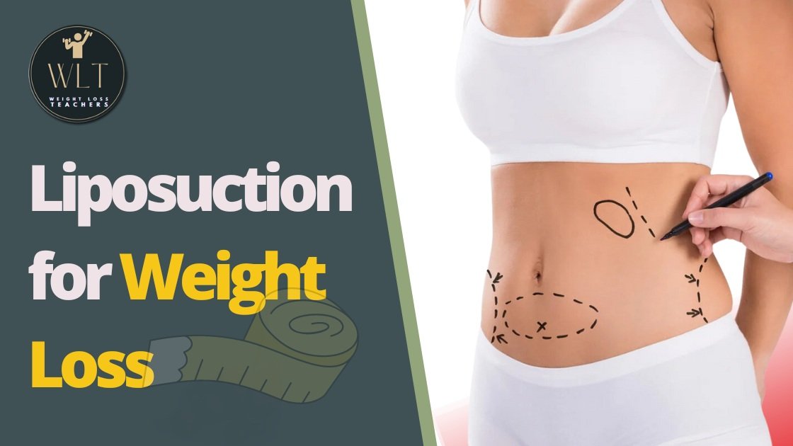 Liposuction for Weight Loss