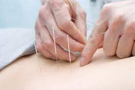 acupuncture-for-weight-loss