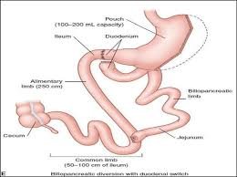 Biliopancreatic Diversion with Duodenal Switch