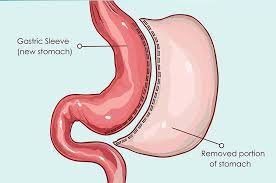 Sleeve Gastrectomy